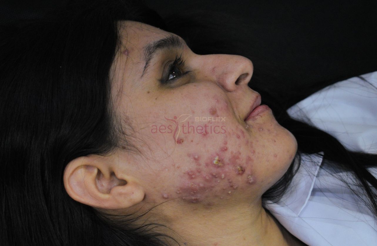 Female patient with visible facial acne