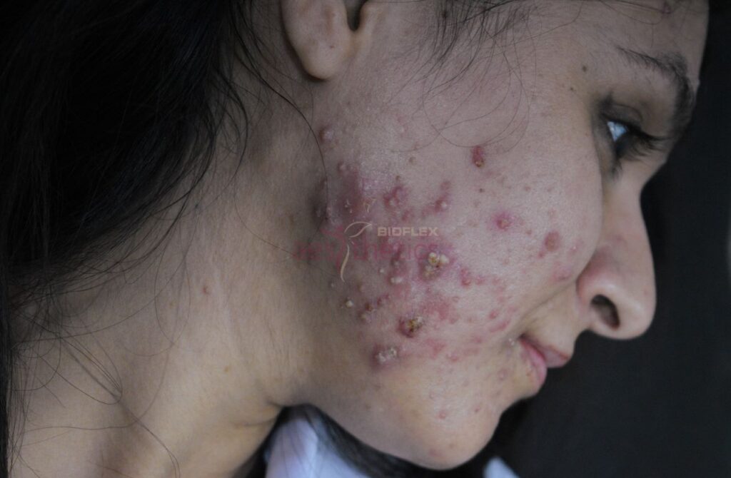 female with acne marks