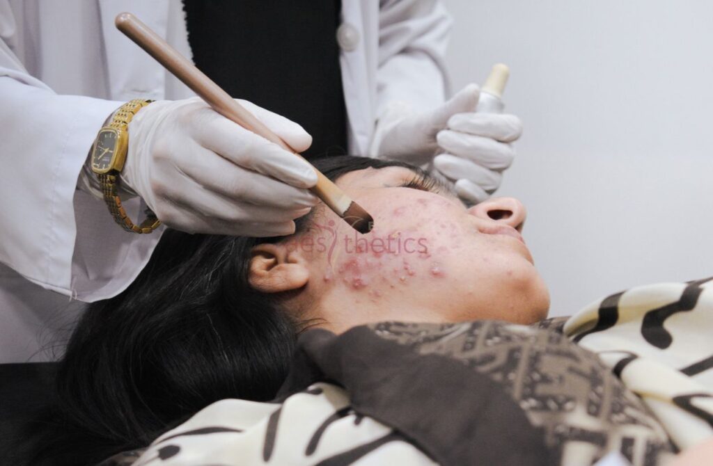 Doctor applying a chemical peel to a patient's face for acne treatment
