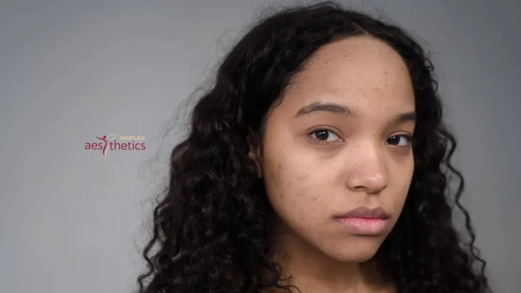 female with visible acne scars