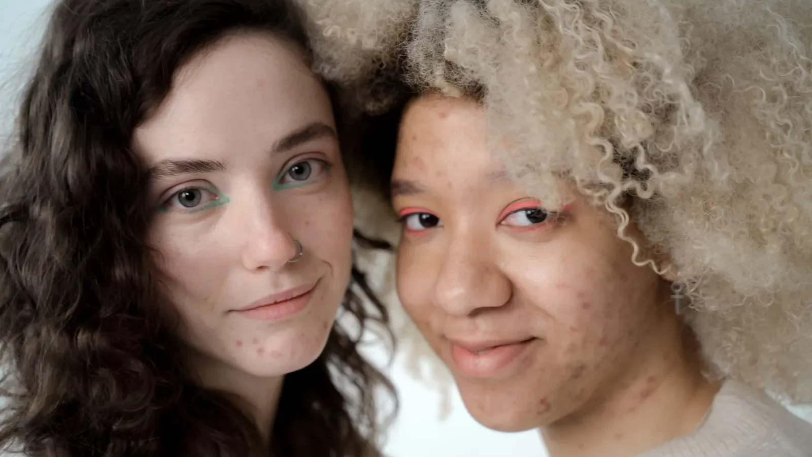 Two females comes for Hormonal acne treatment