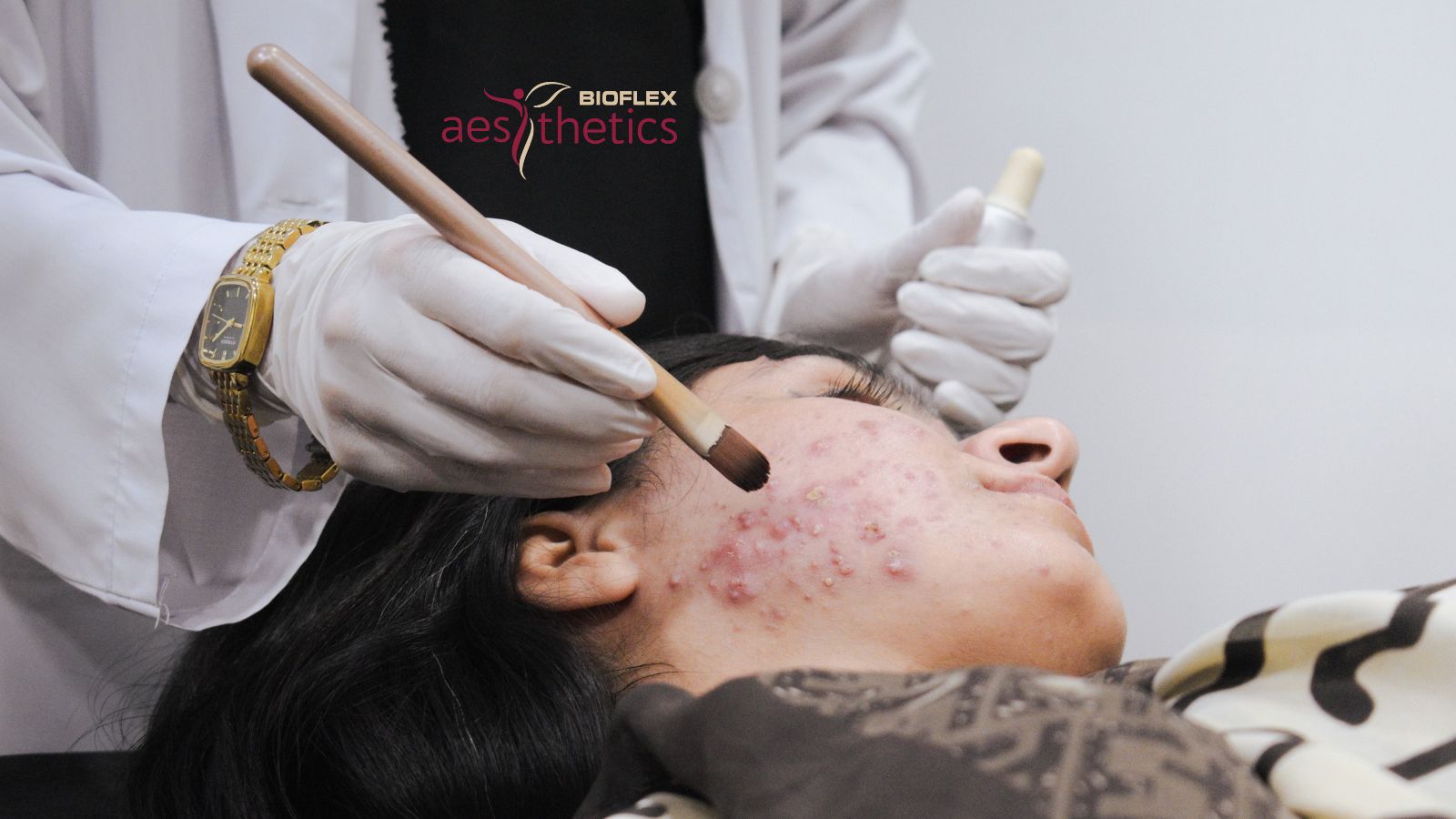 Chemical Peel For Acne Scars: Is It Right For You?